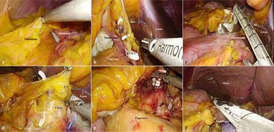 Case Report: Single-port laparoscopic total gastrectomy for gastric cancer in patient with situs inversus totalis